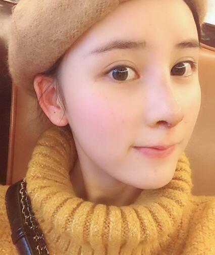 北京藝星整形硅膠假體隆鼻術后兩個月效果