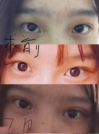 做雙眼皮案例，濟南坤如瑪麗崔金珍雙眼皮案例圖片