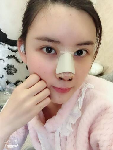 北京藝星整形硅膠假體隆鼻術后第二天正面效果