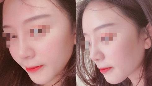 耳軟骨隆鼻術(shù)后三個(gè)月，我有了韓佳人同款美鼻