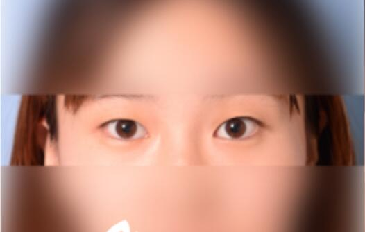 延吉金光善整形雙眼皮一個月效果分享，有對比圖