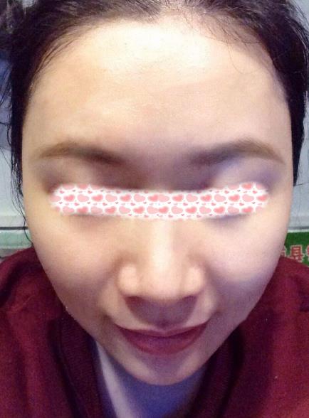 西安米蘭柏羽整形手術(shù)縮鼻翼案例分享術(shù)后兩個月效果