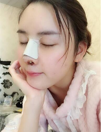 北京藝星整形硅膠假體隆鼻術后第二天側面效果