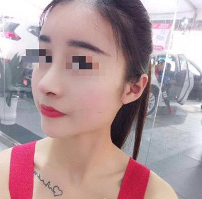 石家莊諾萬整形姚華榮硅膠隆鼻案例分享術(shù)前效果后三個月效果