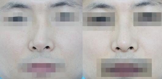 天津時光整形歪鼻矯正案例前后對比圖