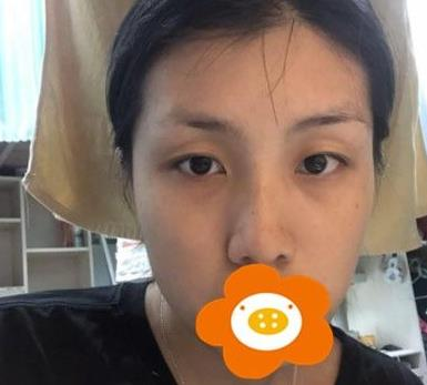 救命，周杰群做的耳軟骨隆鼻恢復(fù)后鼻背線條也太好看了吧