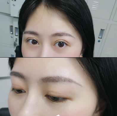 武漢亞太整形雙眼皮案例術(shù)后40天效果 武漢亞太整形雙眼皮案例術(shù)后40天效果