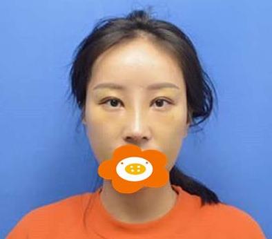 鄭州禾麗做肋軟骨隆鼻術(shù)后一個(gè)月效果 鄭州禾麗做肋軟骨隆鼻術(shù)后一個(gè)月效果