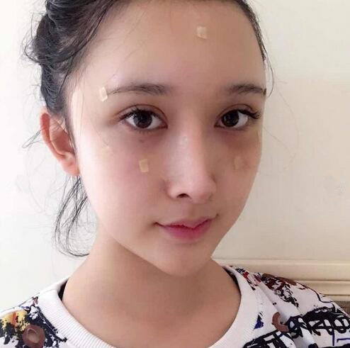 深圳陽(yáng)光全臉填充術(shù)后即刻效果