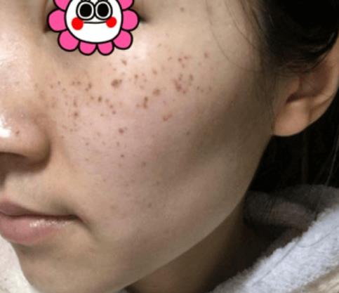 困惱我多年的斑，沒想到在溫州韓美三千塊錢就去掉了