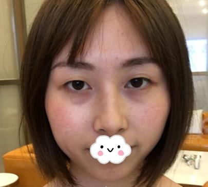 武漢亞太整形雙眼皮案例術(shù)前效果 武漢亞太整形雙眼皮案例術(shù)前效果