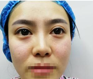 重慶星范整形超體隆鼻術(shù)前效果 重慶星范整形超體隆鼻術(shù)前效果