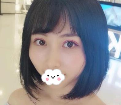 武漢亞太整形雙眼皮案例術(shù)后兩個(gè)月效果 武漢亞太整形雙眼皮案例術(shù)后兩個(gè)月效果