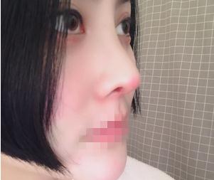 重慶星范整形超體隆鼻半個(gè)月效果 重慶星范整形超體隆鼻半個(gè)月效果