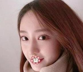 北京彤美耳軟骨隆鼻三個(gè)月效果分享，吐血推薦