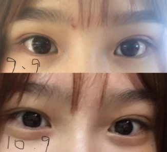 做雙眼皮案例，濟南坤如瑪麗崔金珍雙眼皮案例圖片