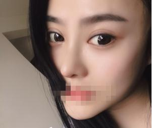 親身經(jīng)驗，重慶星范整形的超體隆鼻真的很自然
