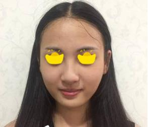 塌鼻子小妹在深圳鵬愛做隆鼻手術，三個月后竟然是這樣的