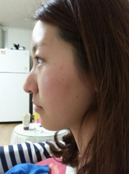 原來駝峰鼻整完這么好看，我再也不是丑美丑美的了