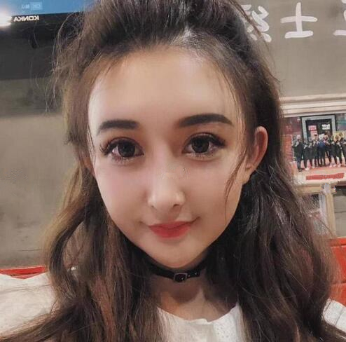 深圳陽(yáng)光全臉填充后兩個(gè)月效果