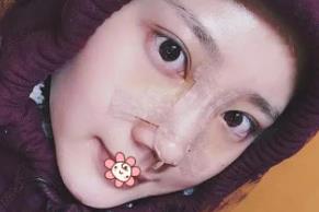 北京彤美耳軟骨隆鼻案例分享術(shù)后兩天效果