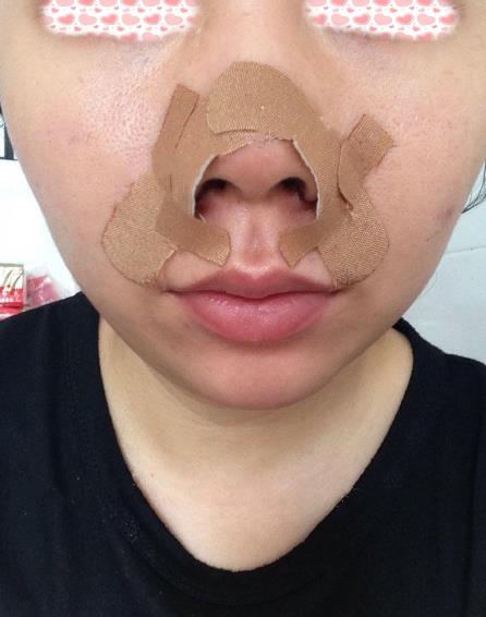 西安米蘭柏羽整形手術(shù)縮鼻翼案例分享術(shù)后即刻效果
