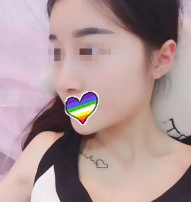 石家莊諾萬整形姚華榮硅膠隆鼻案例分享術(shù)后一個月效果