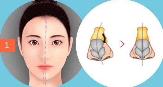 做歪鼻矯正前后效果