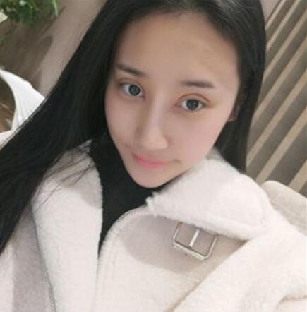 昆明麗都整形雙眼皮修復(fù)案例術(shù)后一個(gè)月