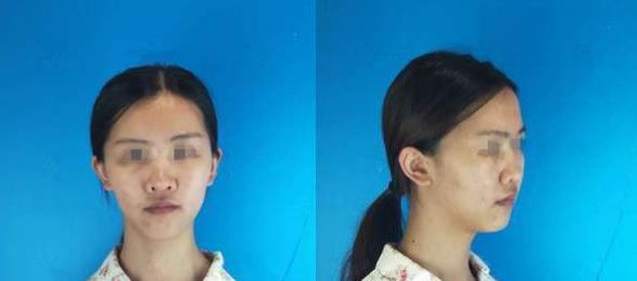 濱州醫(yī)學(xué)院附屬醫(yī)院做隆鼻術(shù)前效果 濱州醫(yī)學(xué)院附屬醫(yī)院做隆鼻術(shù)前效果