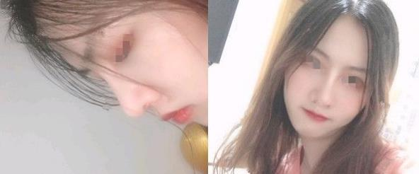 朋友推薦到濱州醫(yī)學院附屬醫(yī)院做隆鼻，效果還挺不錯