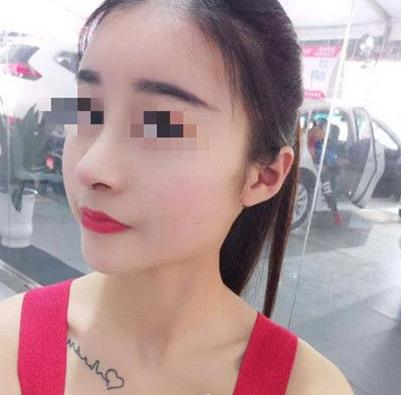 石家莊諾萬整形姚華榮硅膠隆鼻效果分享，同款酒糟鼻值得一試