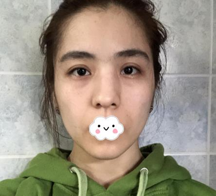 大連沙醫(yī)生整形付德林做的自體軟骨隆鼻效果，給大家做個參考