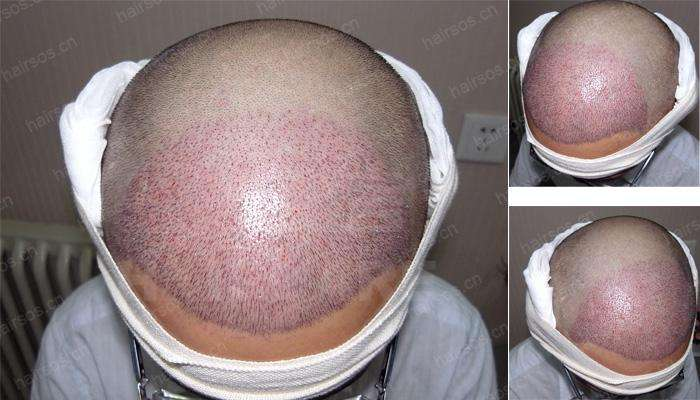 南京美貝爾發(fā)際線種植案例分享，不僅年輕還顯臉小