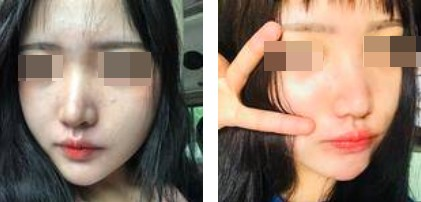 一個(gè)鼻子讓一張臉迅速高級，還不考慮做個(gè)鼻綜合嗎
