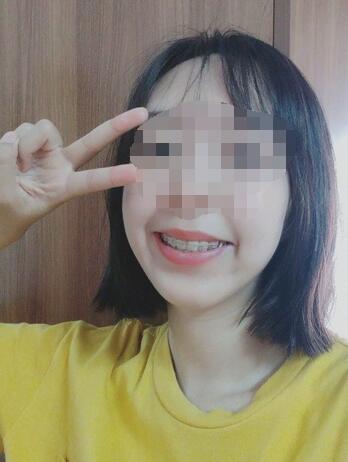 昆山禾豐口腔牙齒矯正案例進入牙齒穩(wěn)固階段