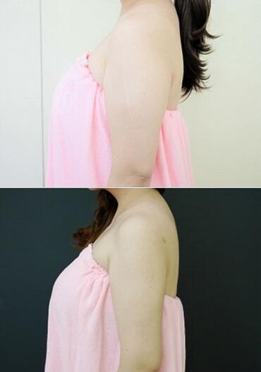 揭陽(yáng)美萊整形手臂吸脂案例術(shù)前效果 揭陽(yáng)美萊整形手臂吸脂案例術(shù)前效果