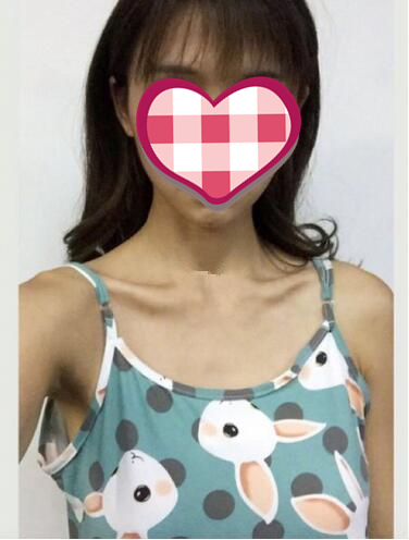 濟南美爾雅整形自體脂肪隆胸半年效果反饋，我都想摸摸看