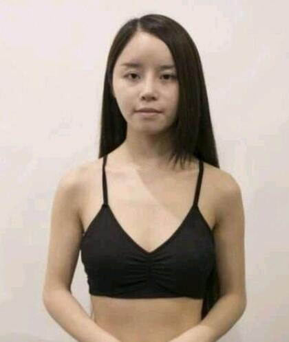 濟南海峽整形假體隆胸術(shù)前側(cè)面