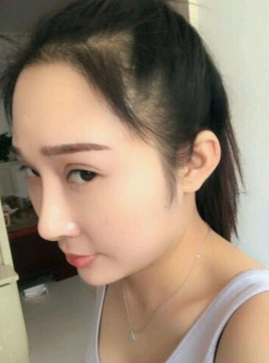 溫州新生植發(fā)種植發(fā)際線(xiàn)案例反饋，與大腦門(mén)說(shuō)拜拜