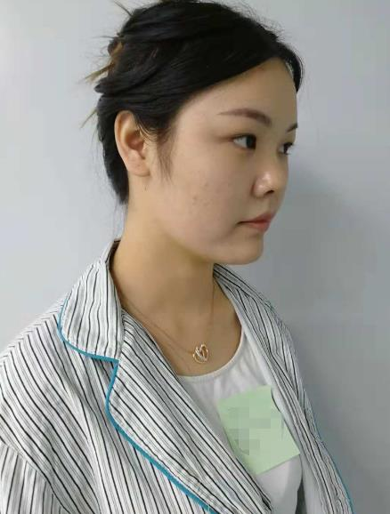 長沙雅美眼鼻整形案例分享，術(shù)后這滿滿的混血感是腫么回事