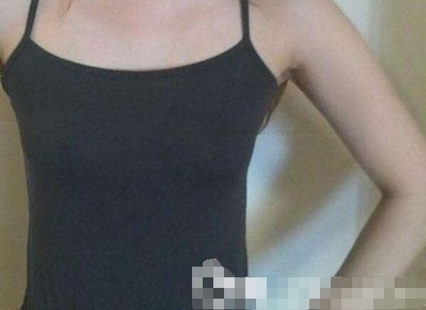 吉安第二醫(yī)院妙桃假體隆胸案例術(shù)前效果 吉安第二醫(yī)院妙桃假體隆胸案例術(shù)前效果