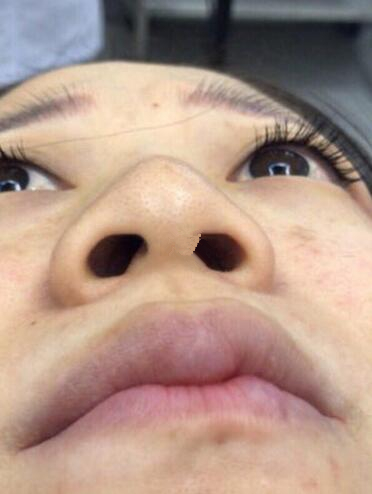 深圳福華整形陳貞宜超體隆鼻術后一個月效果反饋，有圖