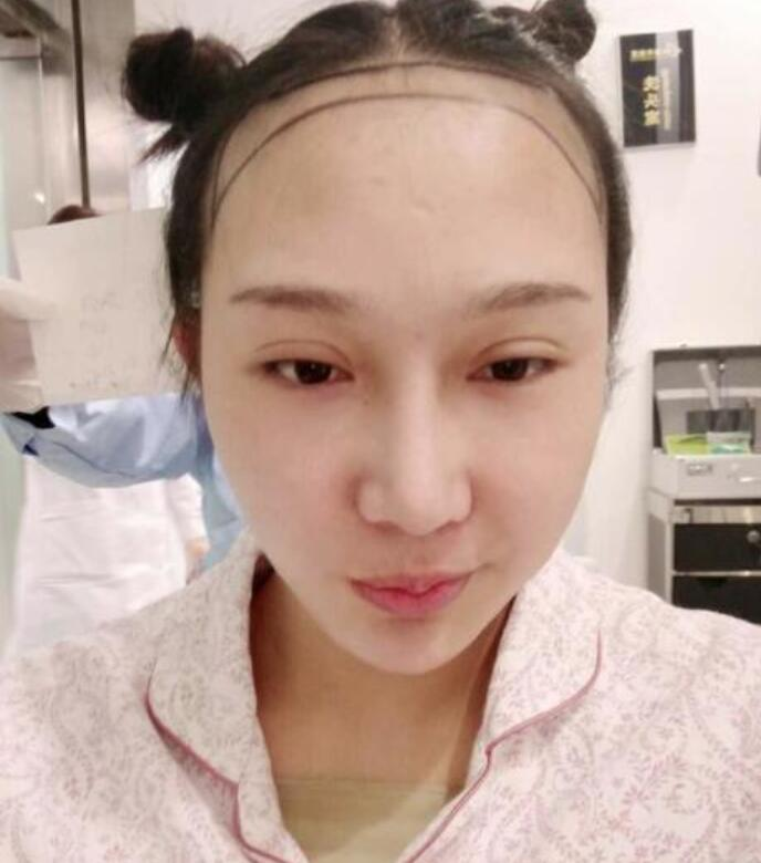 溫州新生植發(fā)種植發(fā)際線(xiàn)案例反饋，與大腦門(mén)說(shuō)拜拜