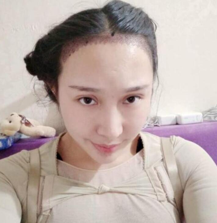 溫州新生植發(fā)種植發(fā)際線案例術后一周效果