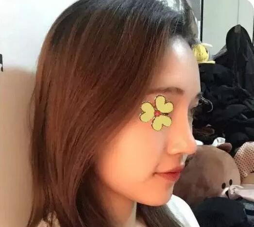 深圳福華整形陳貞宜超體隆鼻術(shù)后二十天