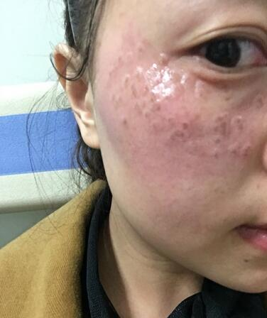 紹興維美整形激光祛斑兩個(gè)療程，皮膚像剝了殼的雞蛋