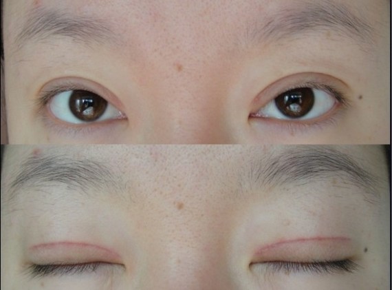 鄭州望京做全切雙眼皮+開外眼角半個月