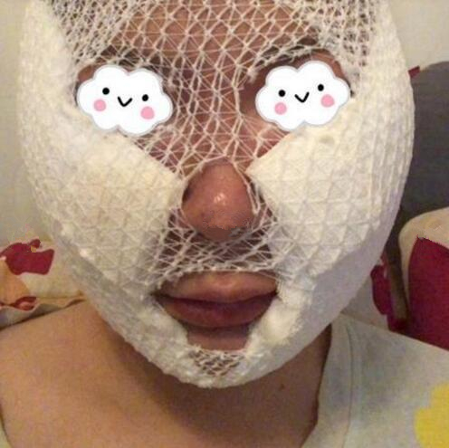 南京藝星整形趙海波面部吸脂術(shù)后第二天