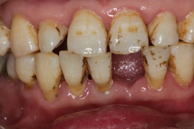 深圳正夫口腔種植牙案例分享，這下可以好好吃飯了